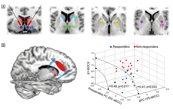 Mechanism and Predictor of the Clinical Efficacy of Psychosurgery in Severe Obsessive-Compulsive Disorder