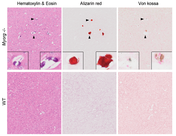 Identification of MYORG as a New Causative Gene for Primary Familial Brain Calcification